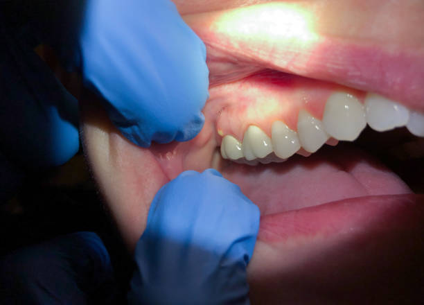 Best Emergency Tooth Extraction in Columbus, OH