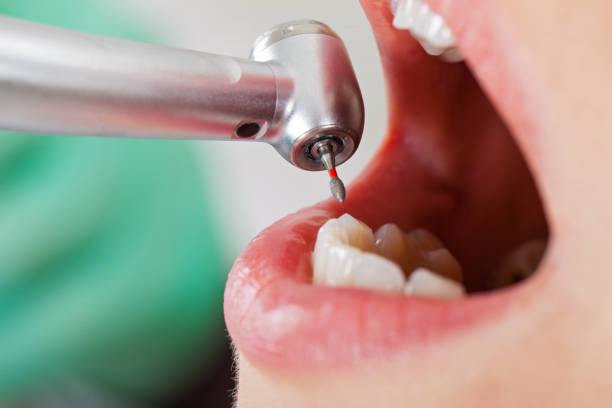 Best Emergency Tooth Extraction in Columbus, OH